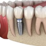 Cum-alegi-clinica-stomatologica-pentru-interventia-de-implant-dentar.jpg